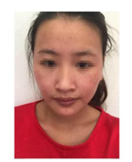 红血丝 红血丝